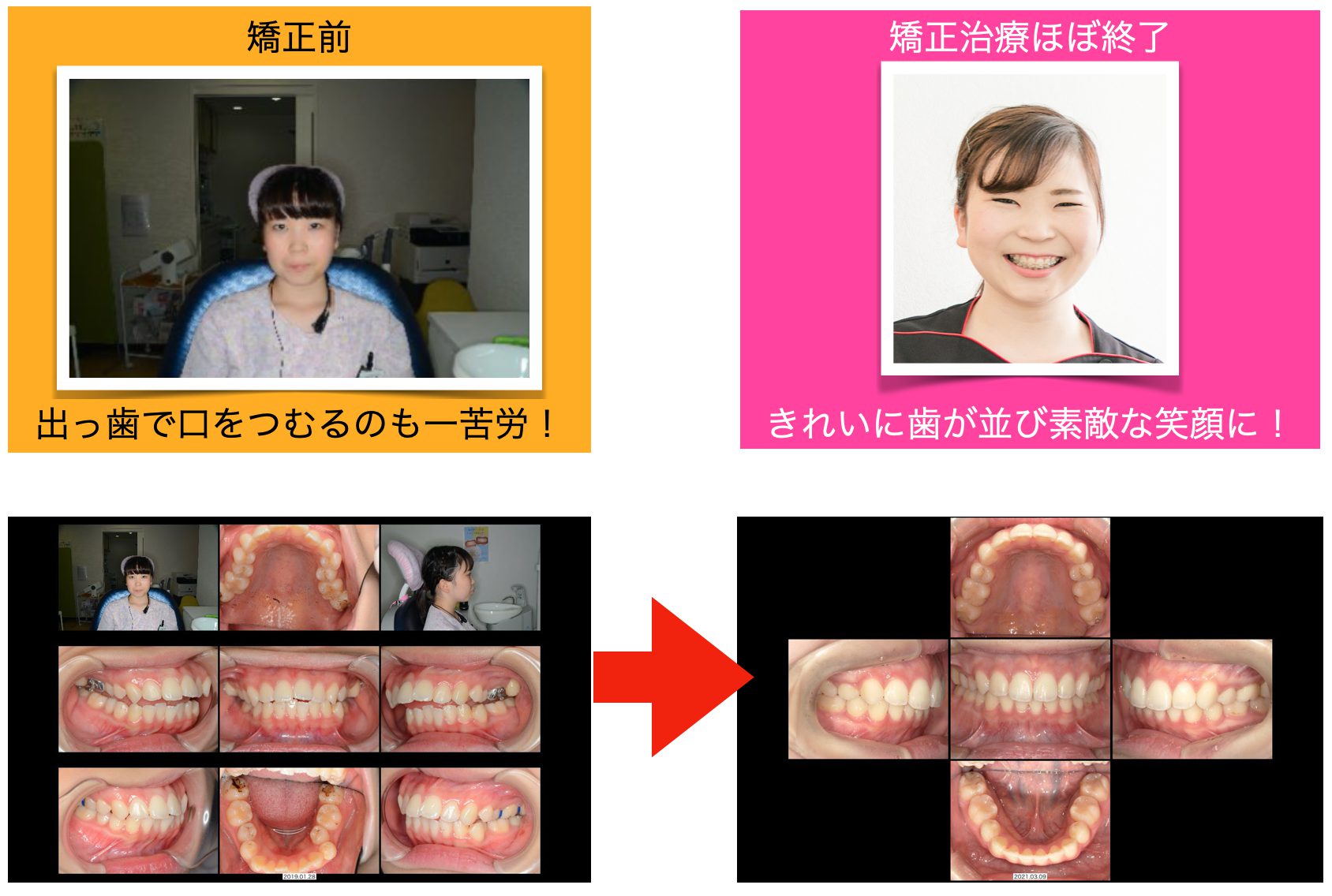 歯列矯正で美人になったと言われる真相｜顔立ちの変化と劇的垢抜けの秘密