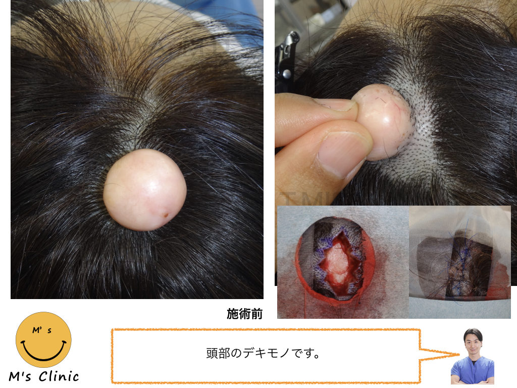 頭のできものは放置厳禁？痛い・かゆい原因と受診目安を徹底解剖
