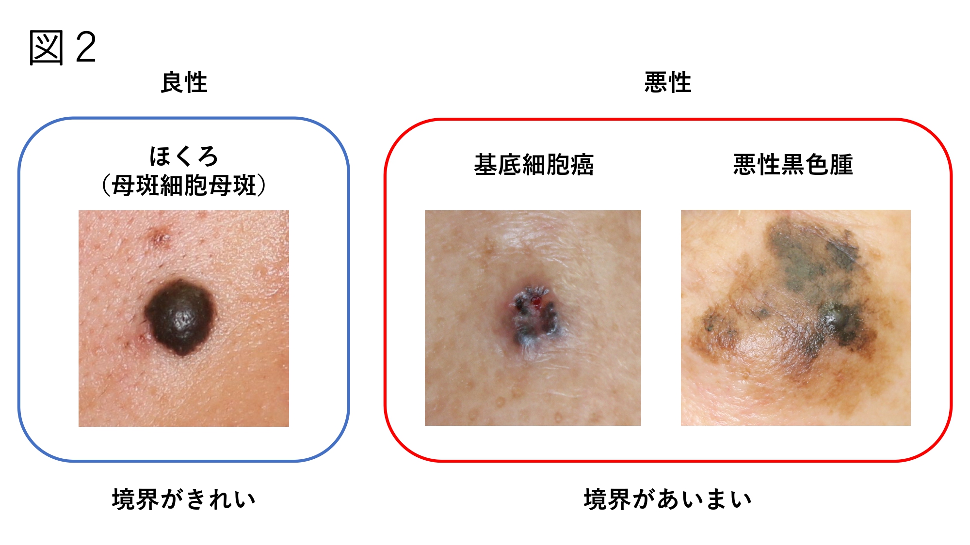ほくろが多い人はなぜ？急増の原因・危険な病気の見分け方と除去法