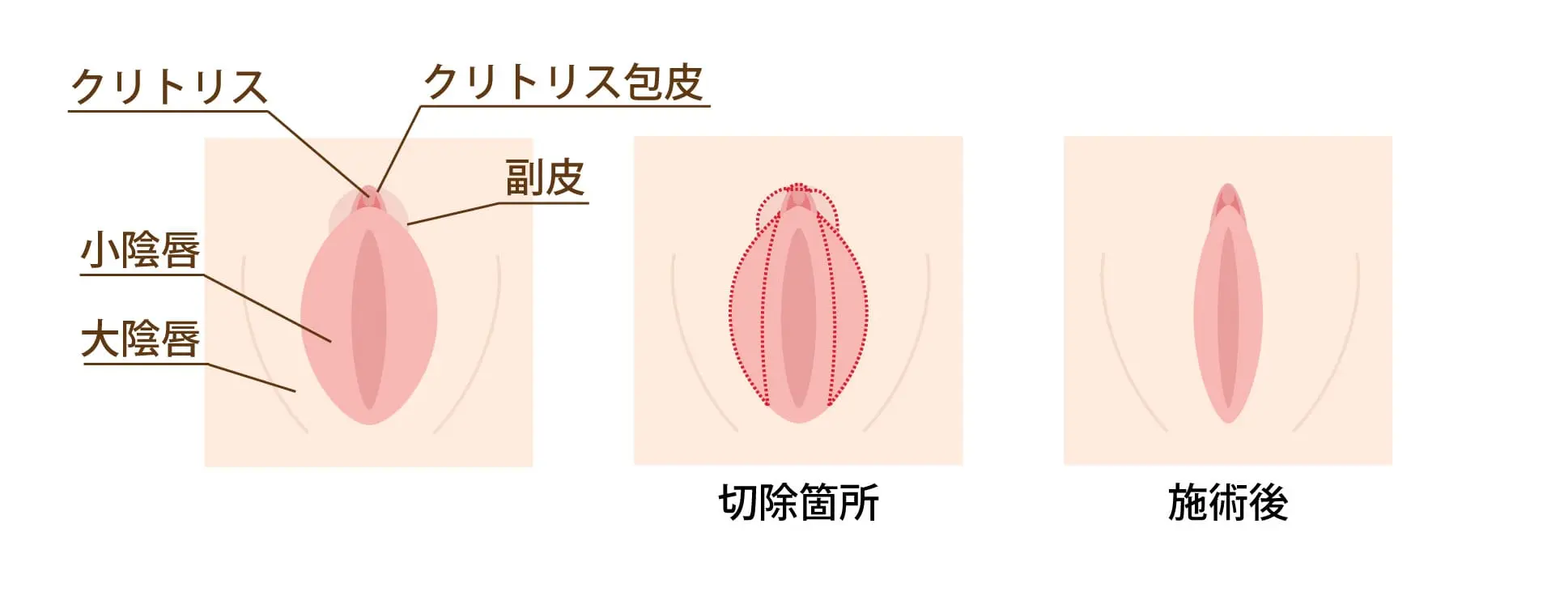 恥垢とは？溜まる原因と臭いの正体・正しい落とし方を専門医視点で徹底解説
