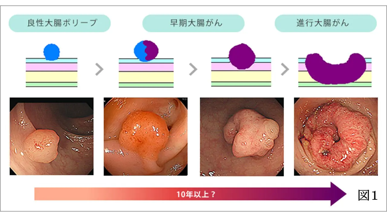 大腸ポリープ症状を見逃すな｜無症状でも進行する構造的理由と血便・便通異常の危険サイン