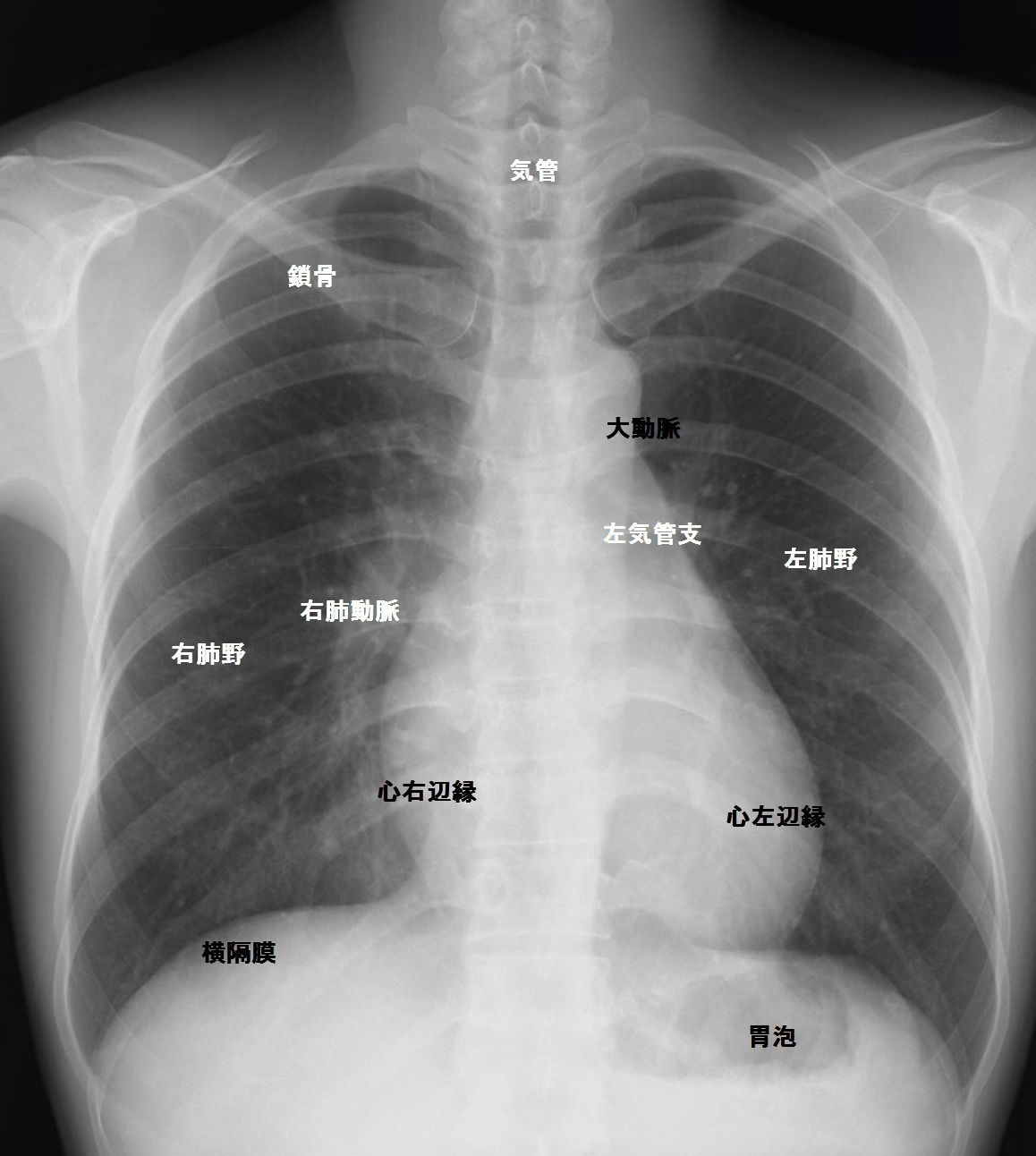 【胸部X線検査】異常の“限界”と再検査基準──白い影でどこまでわかる？2026年最新ガイド