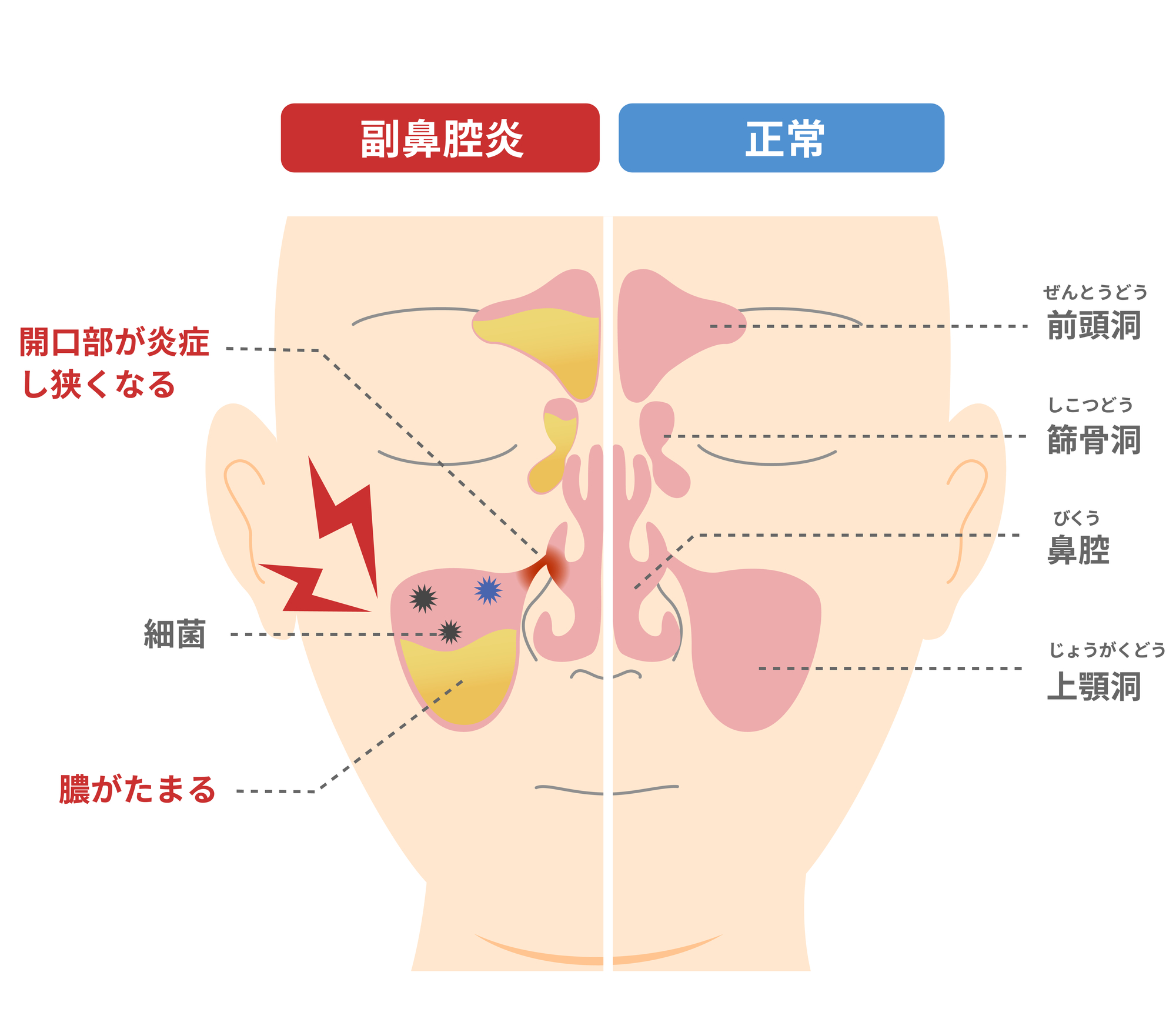 蓄膿症の治し方完全ガイド｜市販薬の効果から即効ケア・受診目安まで解説