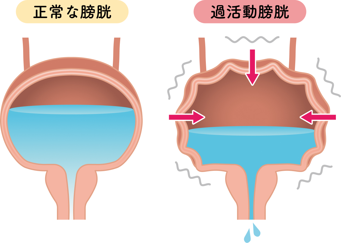 過活動膀胱の決定的な原因と治し方｜急な尿意を抑える2026年最新対策