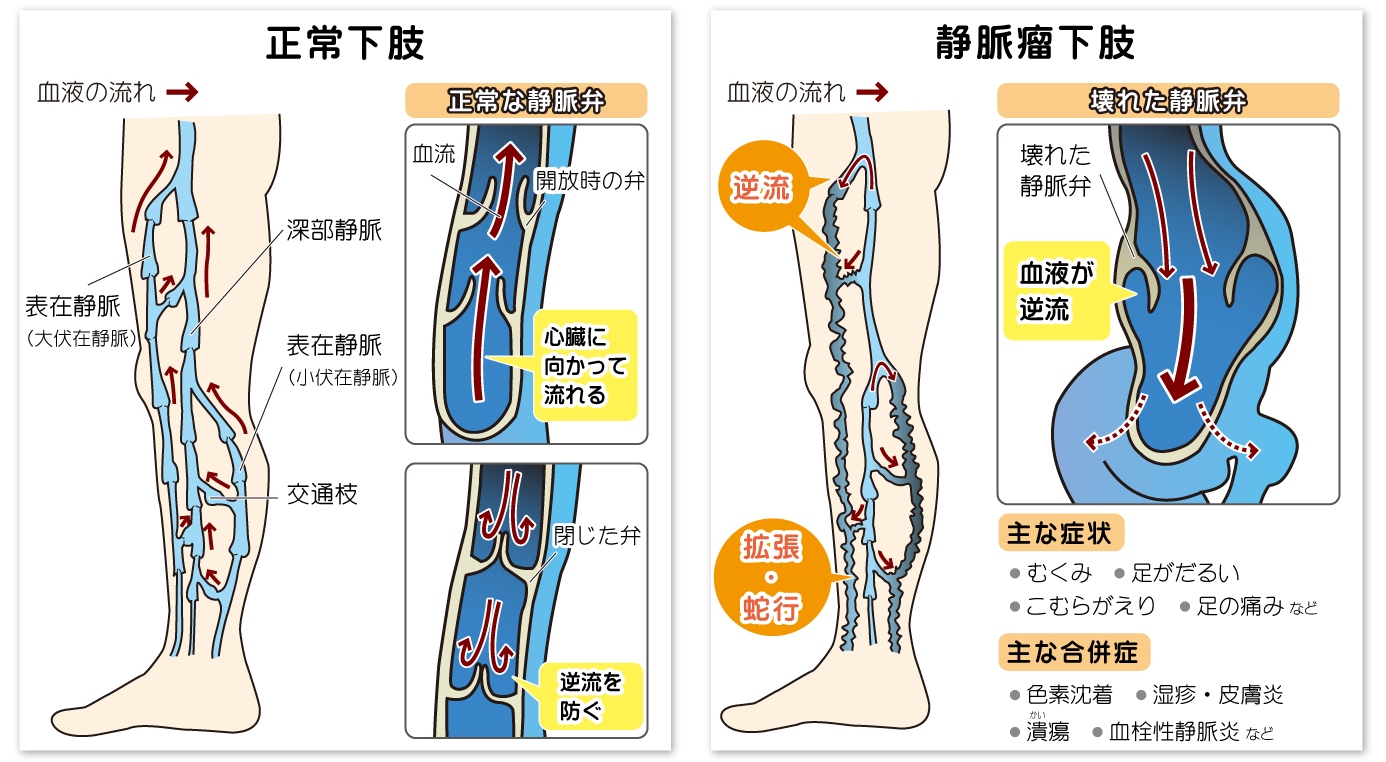 むずむず脚症候群の症状と原因｜夜眠れない足の不快感の正体と対処法