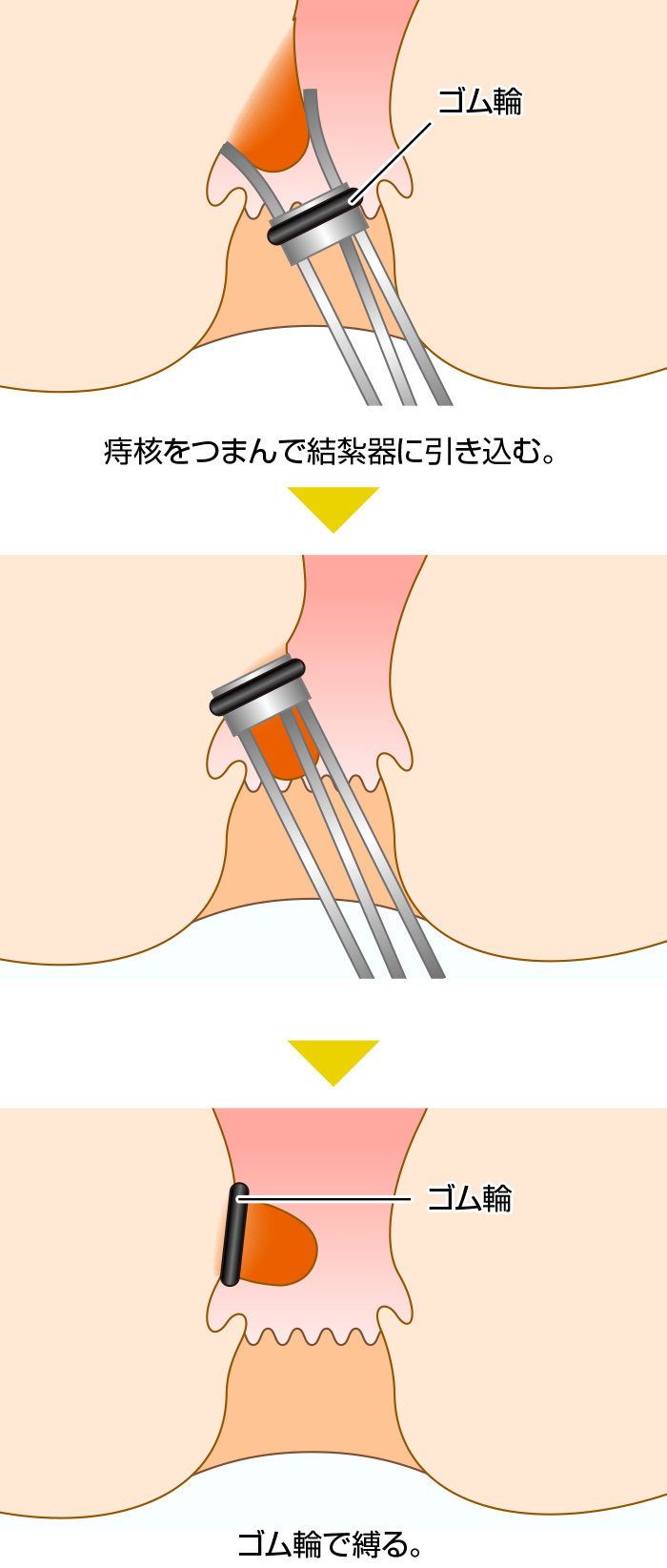 いぼ痔手術の痛みと費用を徹底検証！切らない治療と切除術の差