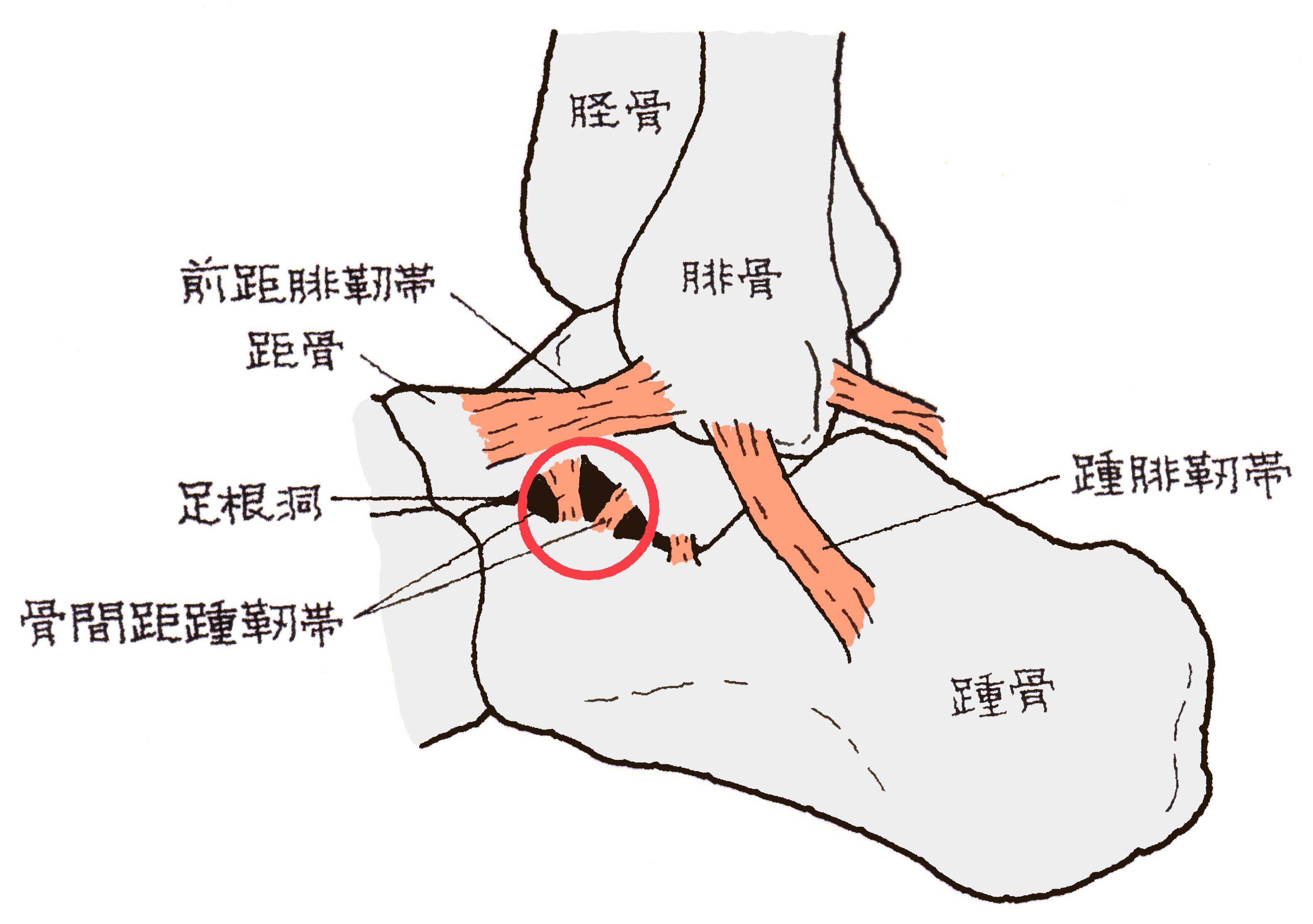 足根洞症候群が治らない理由とは？くるぶし外側の痛みと最新治療の全貌