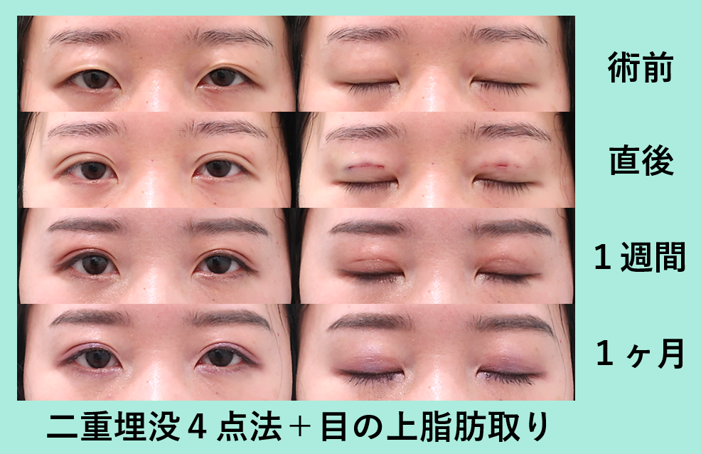 2026年最新トレンド：なぜ「平行二重」の芸能人は視線を奪い続けるのか？時代と共に進化する目元の美学