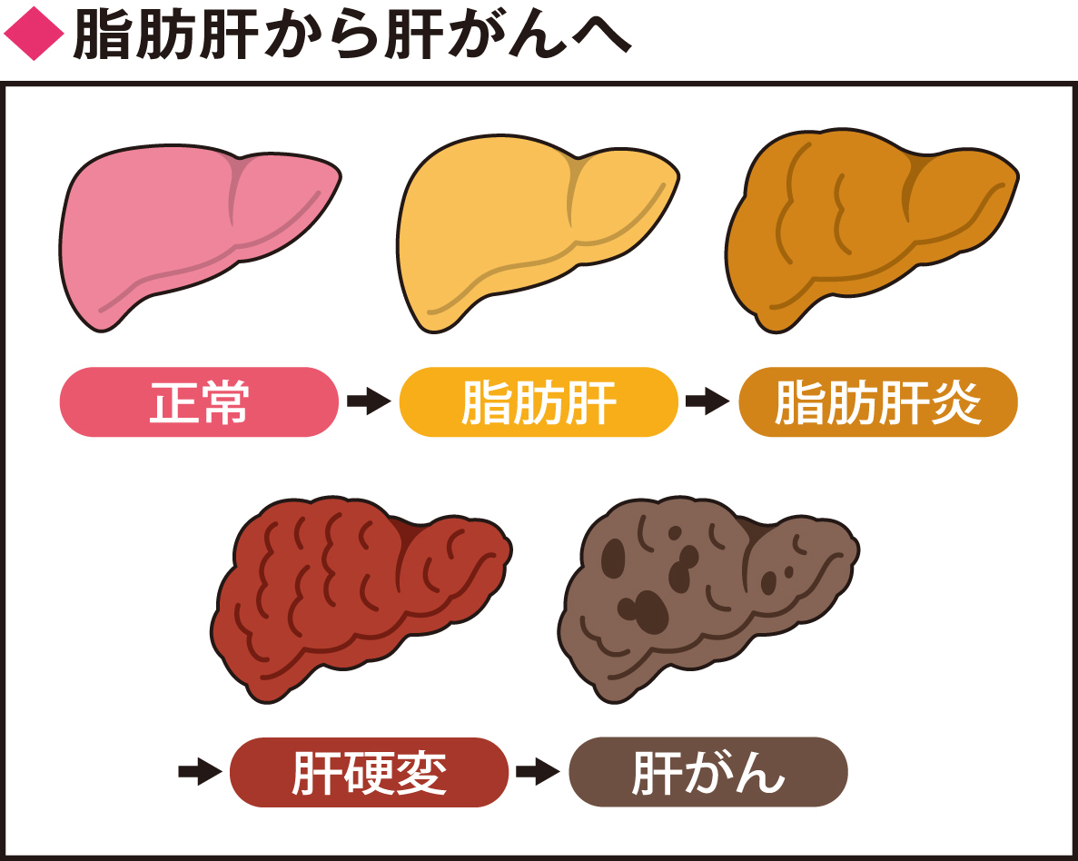 肝脂肪とは何か、医者が本気で警告する“静かな脂肪の溜め込み”の正体