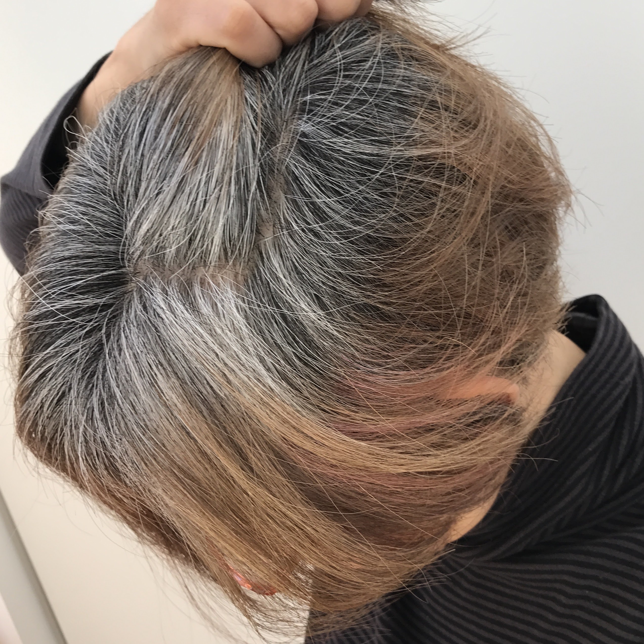 2026年、なぜ今「アンダーヘアの白髪」相談が急増しているのか？医師が明かす原因と最新対策の全貌