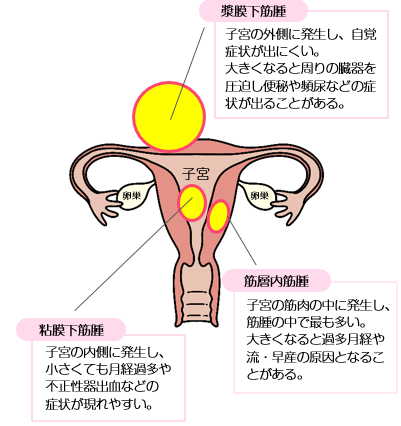 ネットの噂を科学する：子宮筋腫とルイボスティーの「本当の効果」を医師に直撃【2026年最新ヘルスケア】