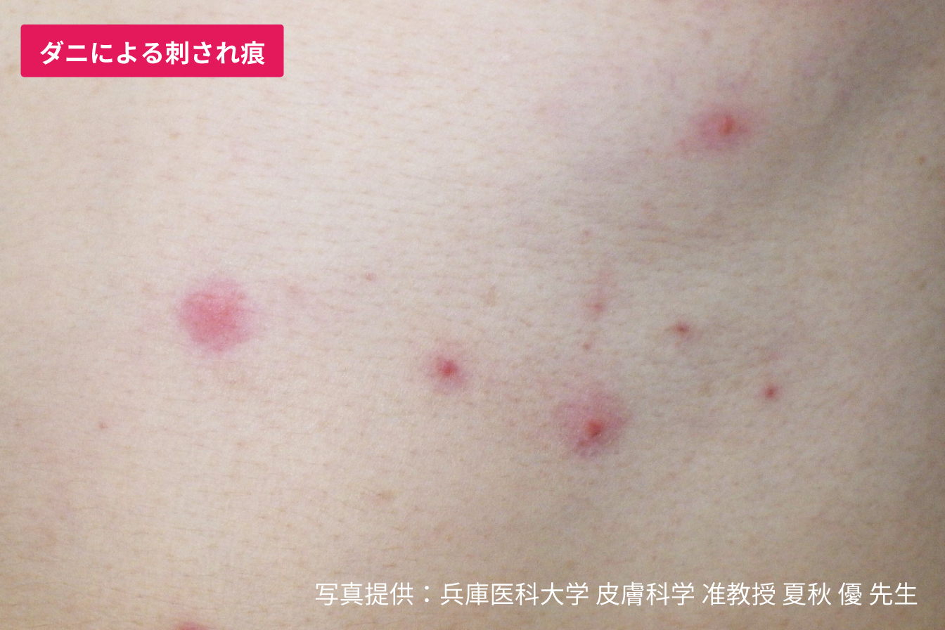 ダニに刺された跡の特徴は？蚊との違いやしこり・治し方を徹底解説