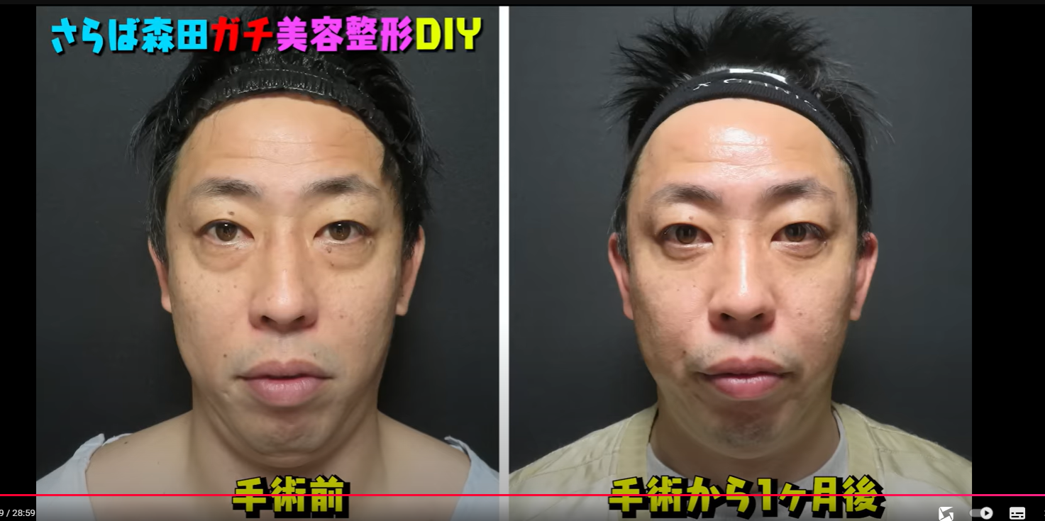 クマがひどい芸能人の真相！過密労働か老化か？激変した現在の姿と理由