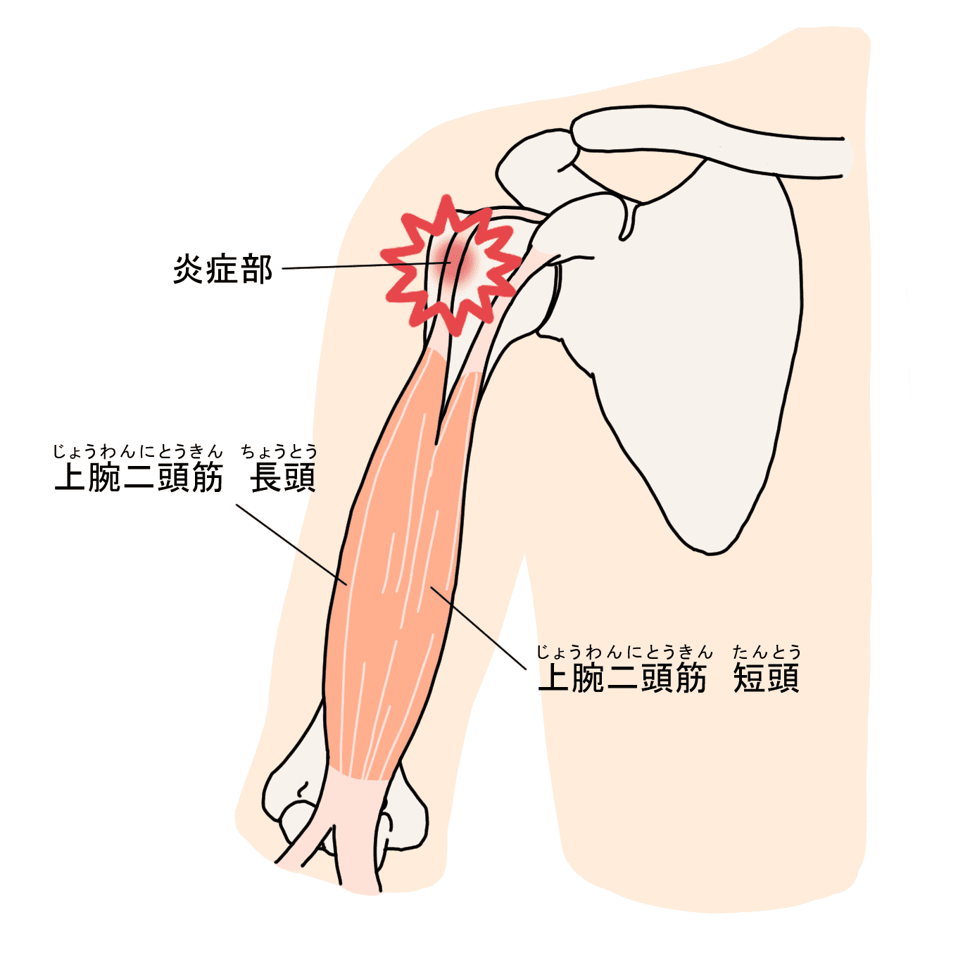 肩の付け根が痛い原因と治し方｜四十肩・腱板断裂の見分け方と対処法
