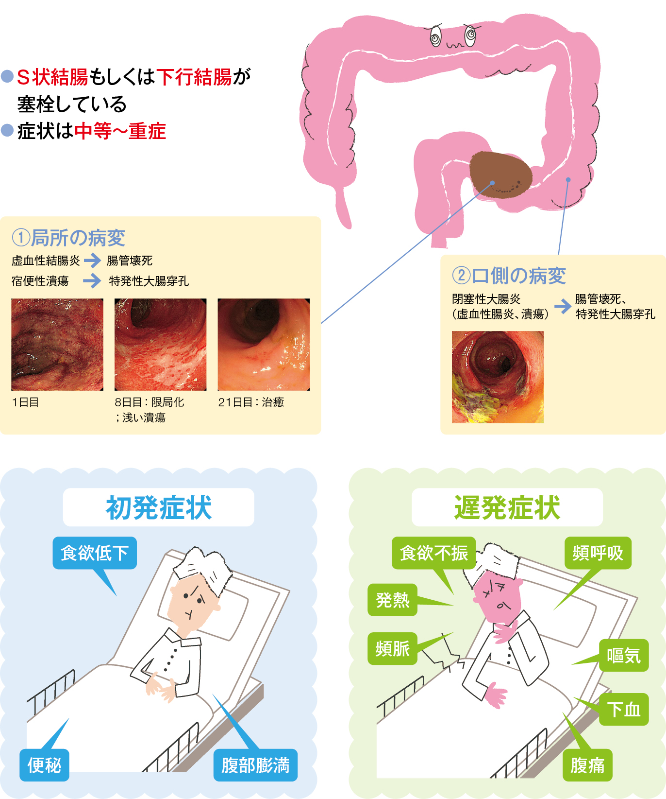 【2026年最新】腸閉塞の初期症状とは？便秘との決定的な違いと危険な前兆