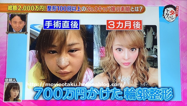 1億越えキャストが明かす「美容投資」の真実――2026年、夜の街で起きている美容医療の地殻変動