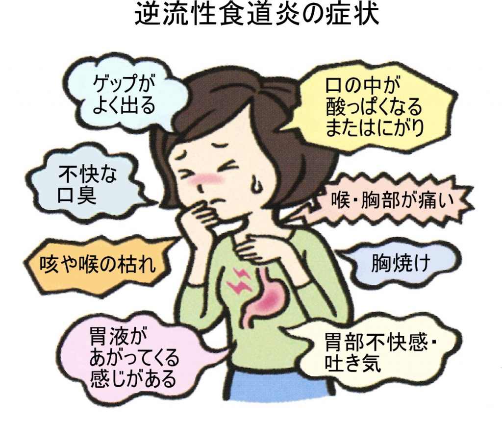 逆流性食道炎の初期症状と原因｜胸焼け・喉の違和感を治す2026年最新治療