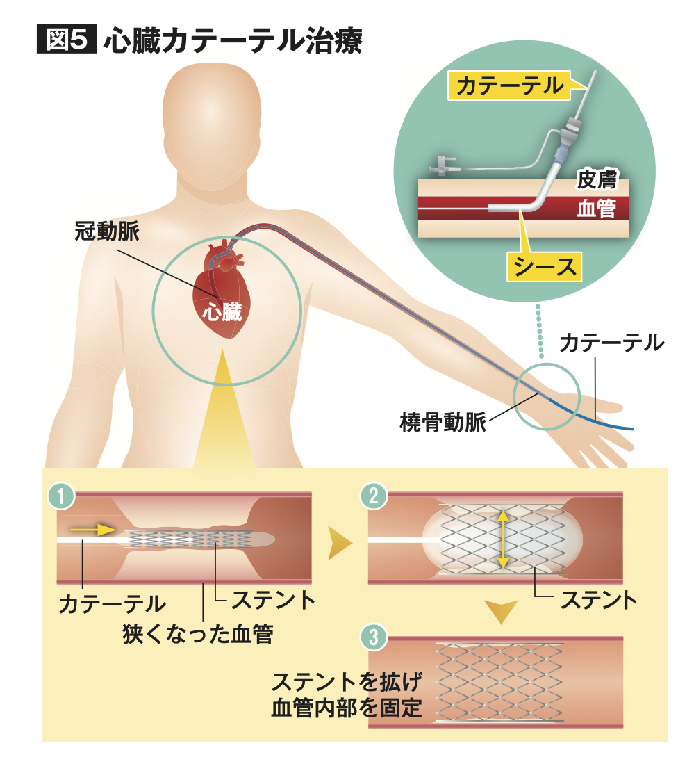 狭心症の手術選び｜カテーテルとバイパスの違い・費用・リスクを徹底解説