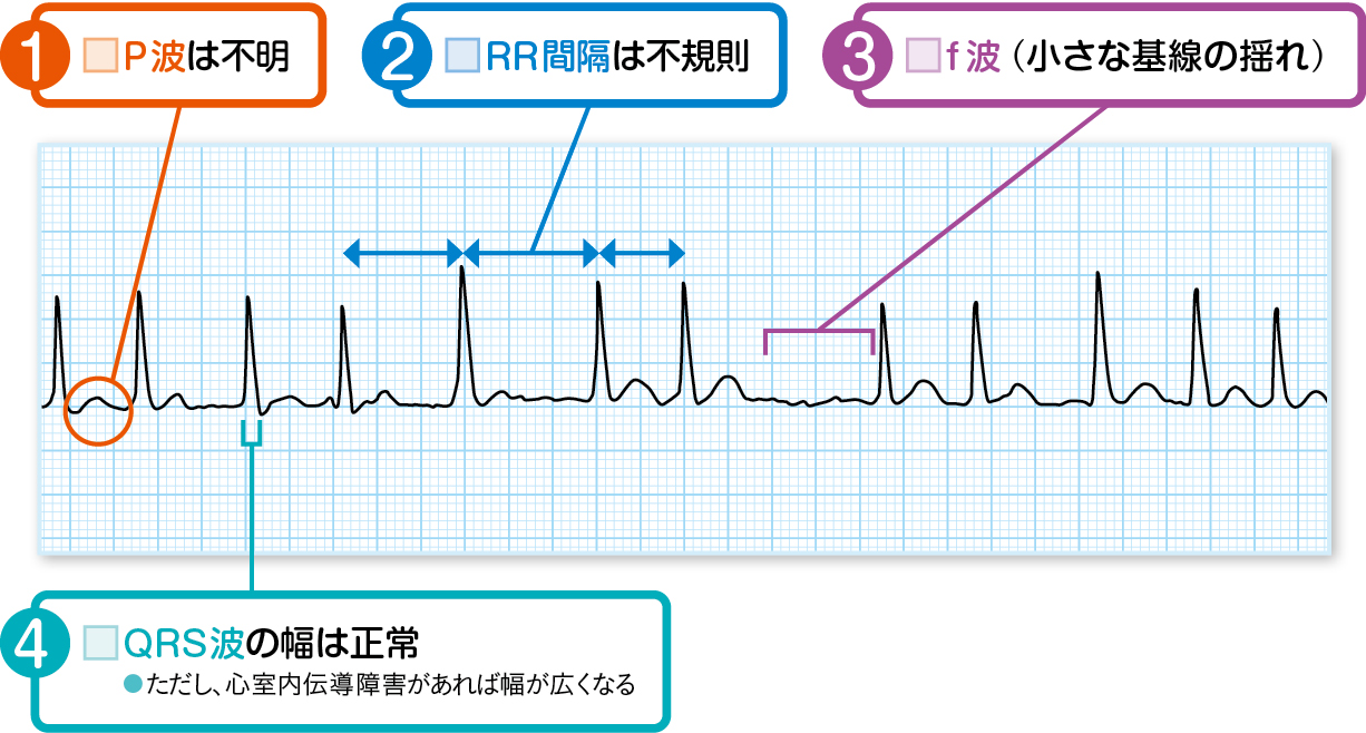 心房細動の心電図波形で見逃せない危険サインと脳梗塞予防の決定打