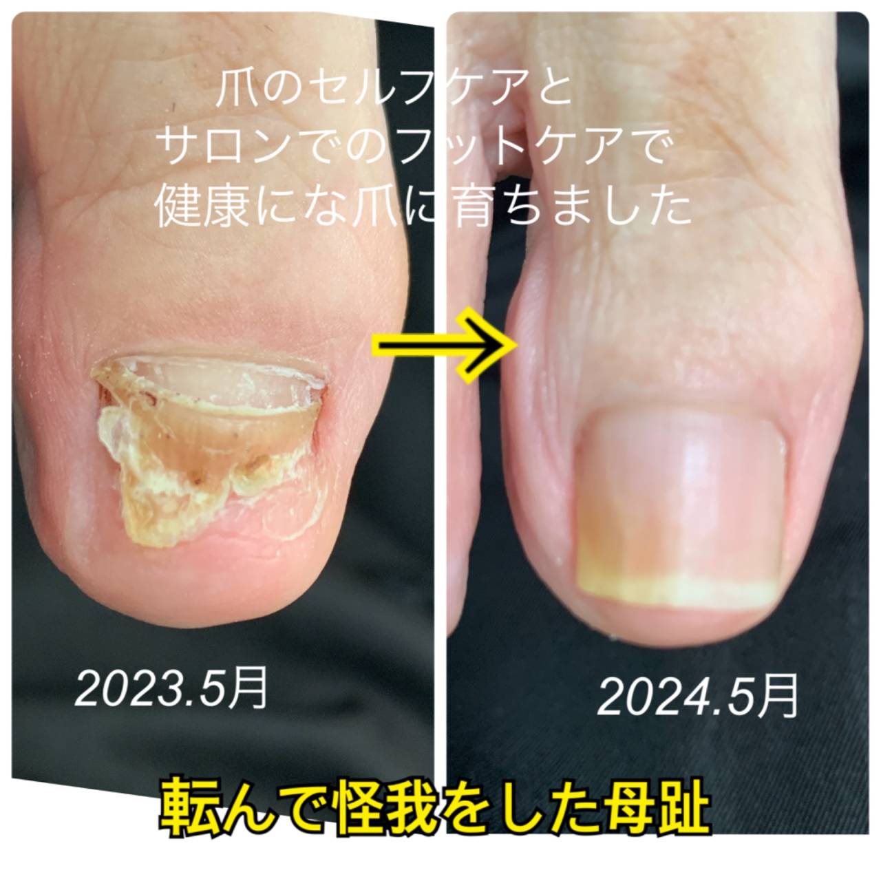 爪が割れたら伸びるまで何ヶ月？全治期間と最短で治す応急処置
