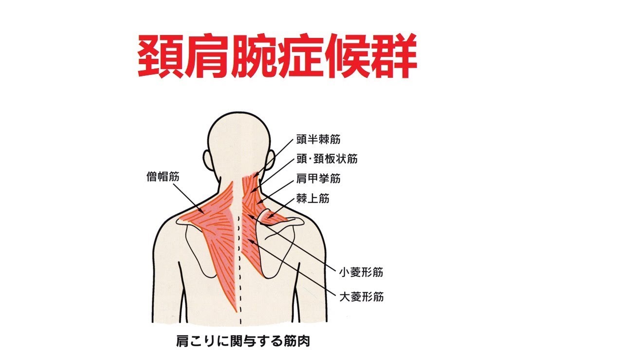 頸肩腕症候群の治らない原因と最新治療｜重症化を防ぐ診断と労災基準