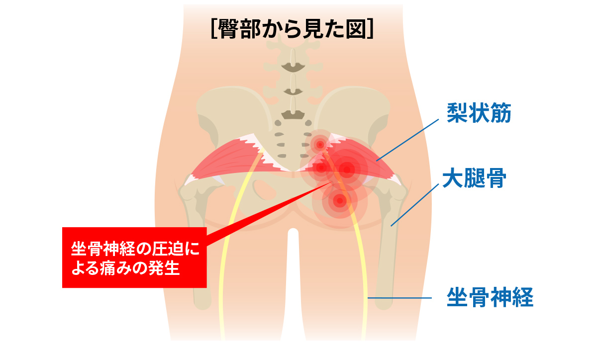 お尻の奥の痛み・しびれは梨状筋が原因？坐骨神経痛との違いと改善法