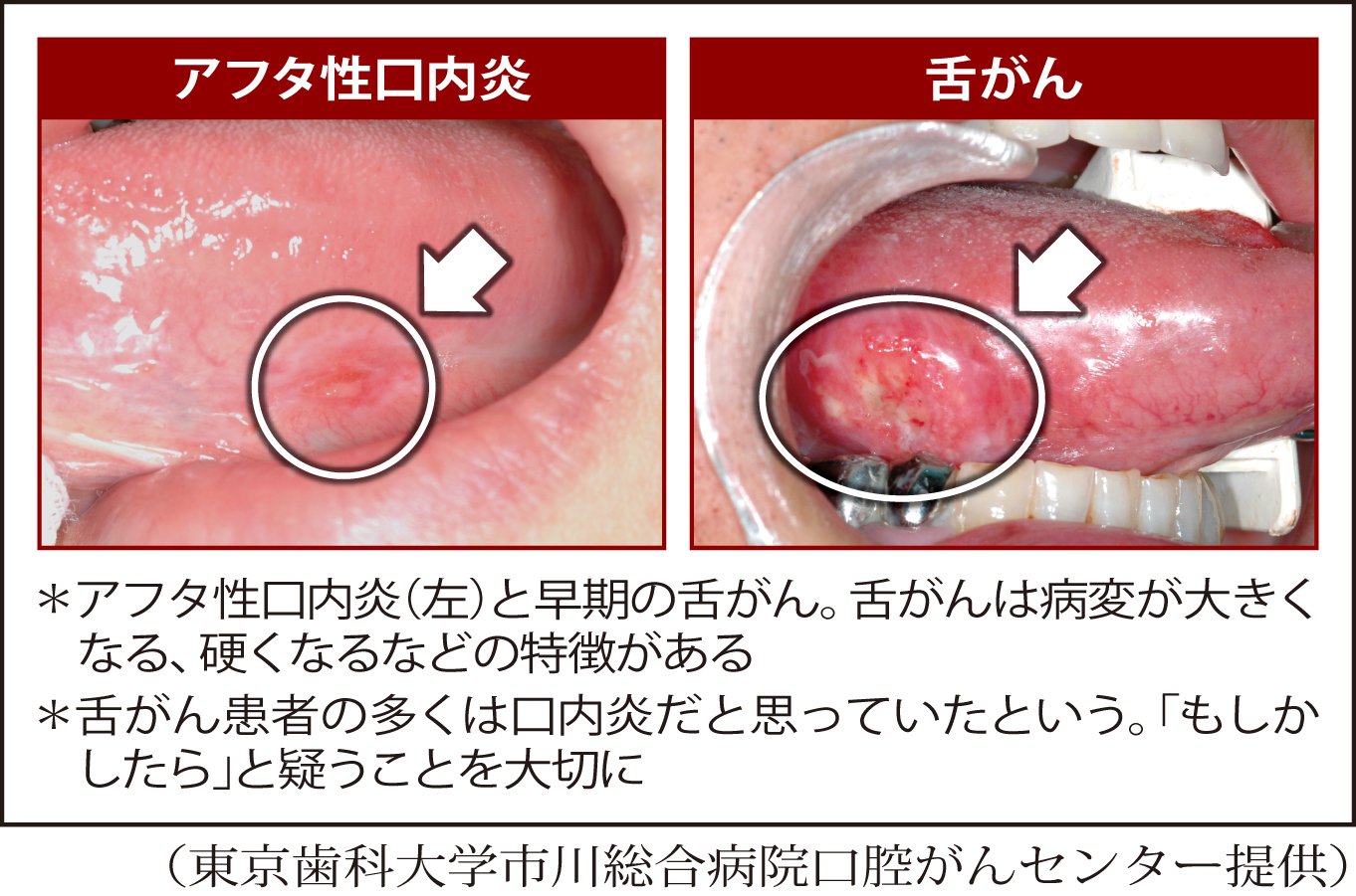 舌にできる口内炎、繰り返す理由と正しい治し方｜白い・赤い症状別の見極め