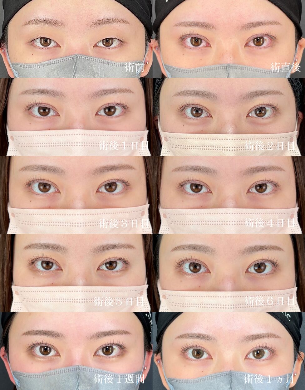 【埋没ダウンタイムの全真相】2026年最新の症例データと回復実態