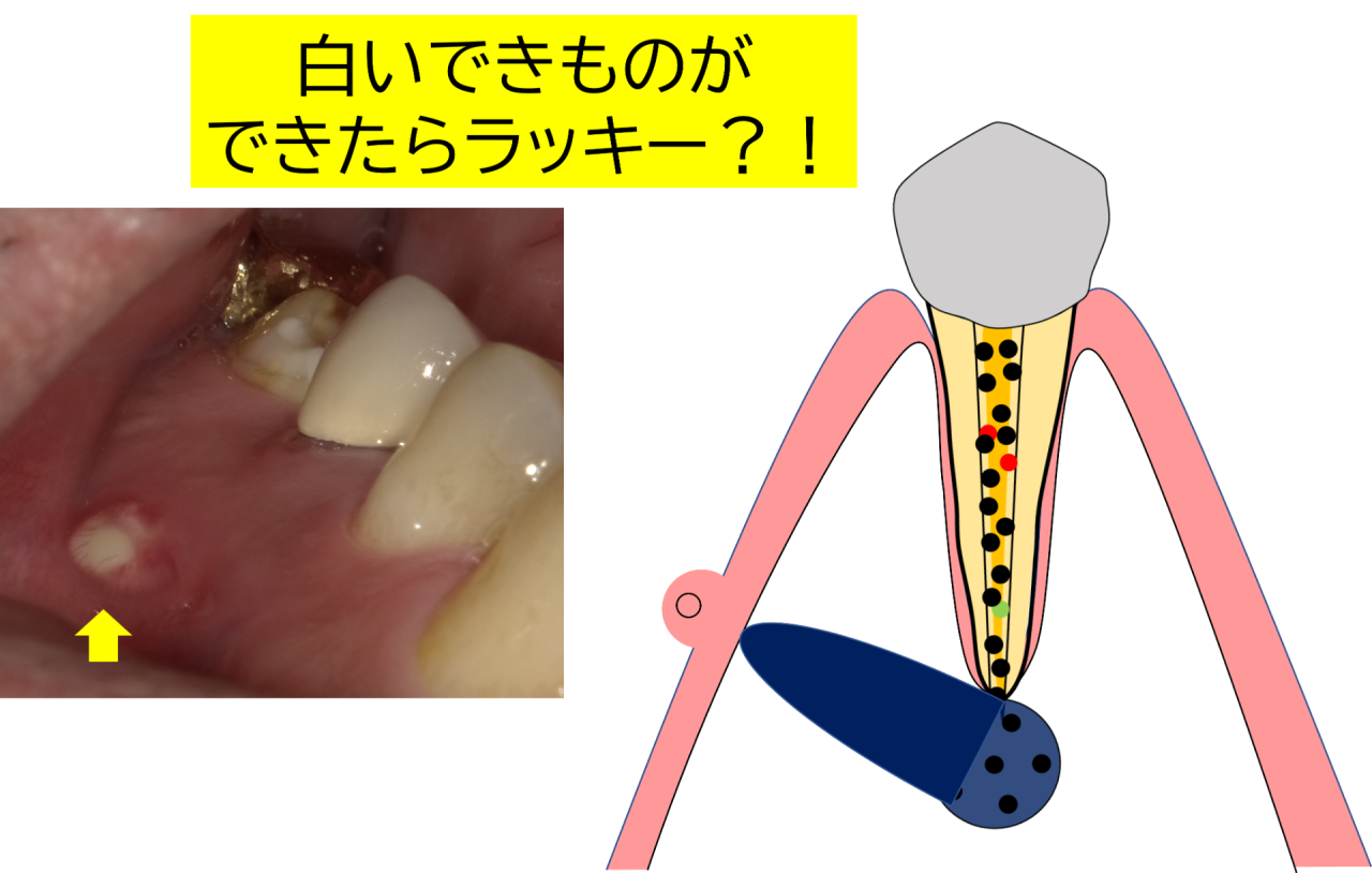 歯茎の白いできものは危険？痛くない原因と放置厳禁の病気を徹底解説