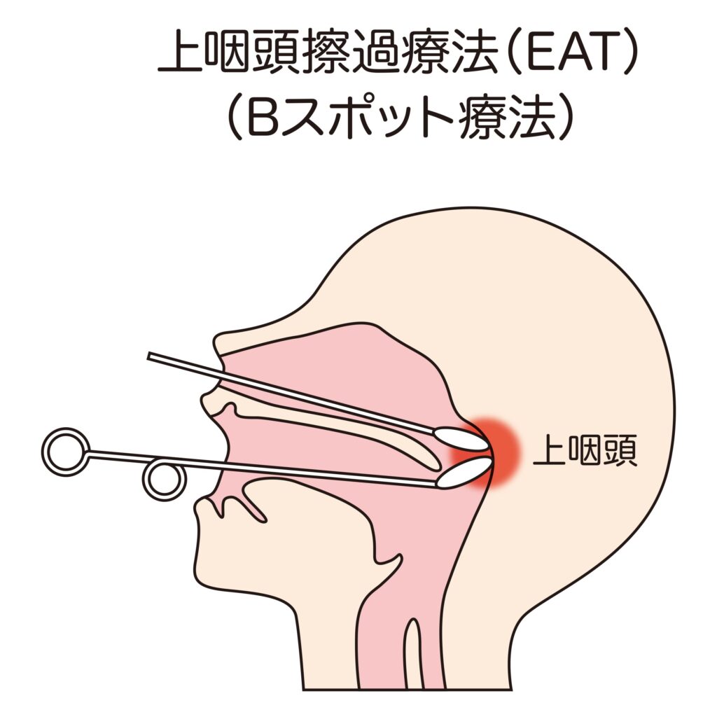 鼻と喉の間が痛い原因と治し方｜上咽頭炎のサインと受診の目安
