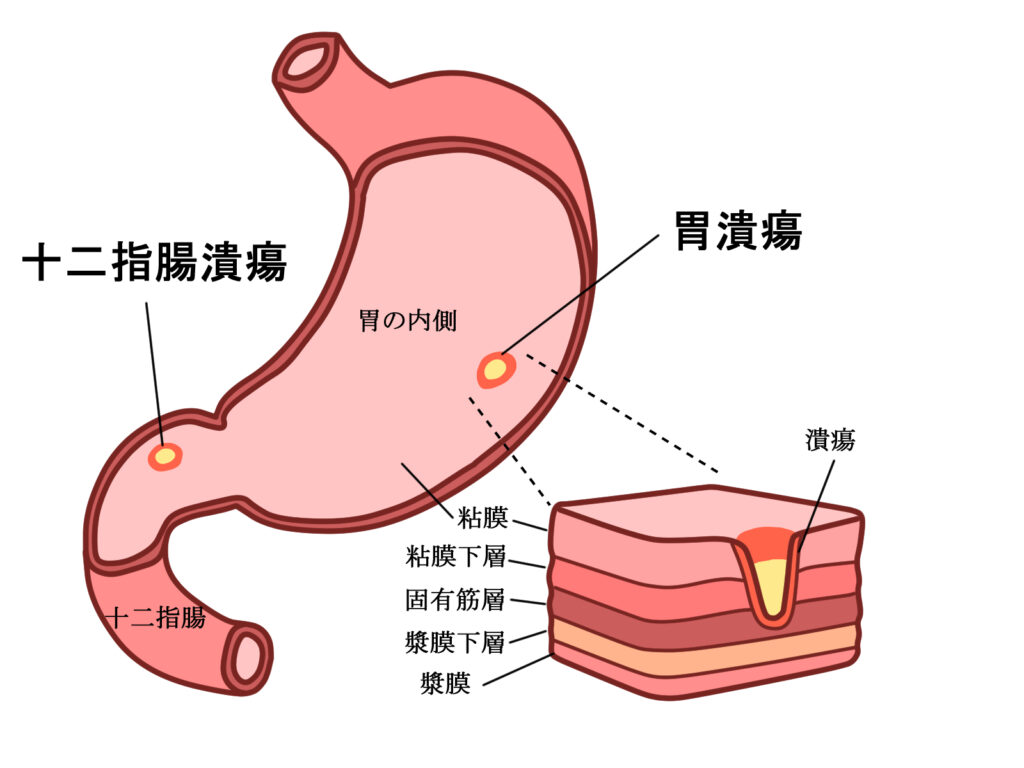 胃・十二指腸潰瘍はなぜ繰り返す？再発と放置リスクを2026年最新データで総点検
