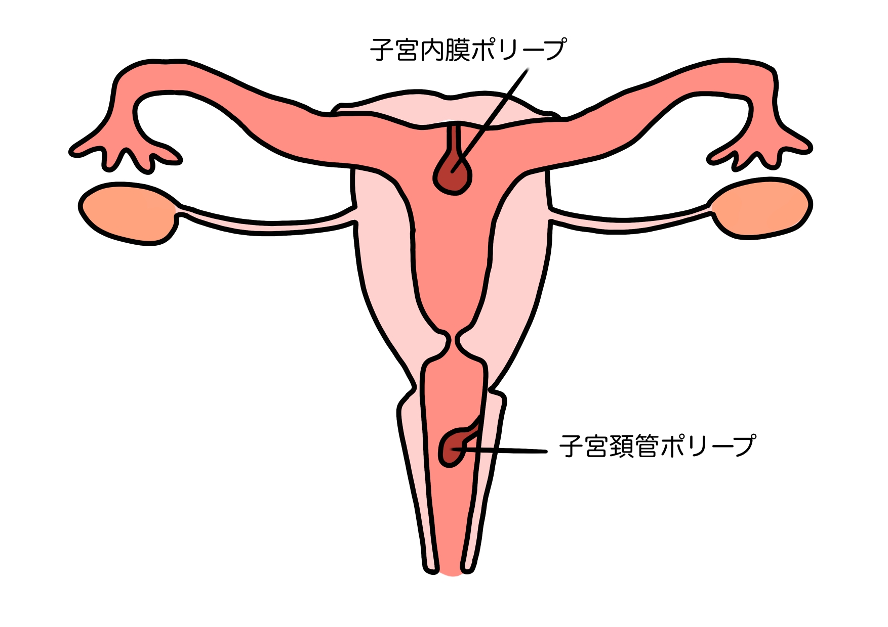 子宮内膜ポリープは自然に取れる？生理排出の確率や放置リスク・手術の基準
