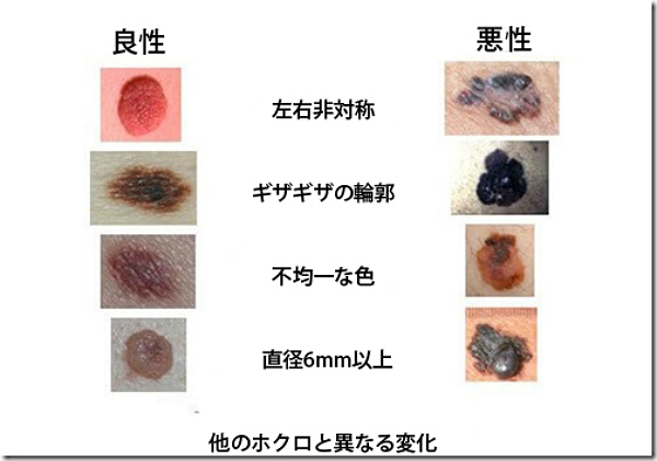ほくろの変形は危険？悪性黒色腫を見破るサインと皮膚科の識別法