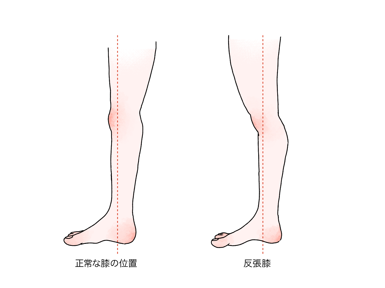 反張膝の原因を徹底解明！骨盤前傾と太もも裏の筋力低下を正す改善法