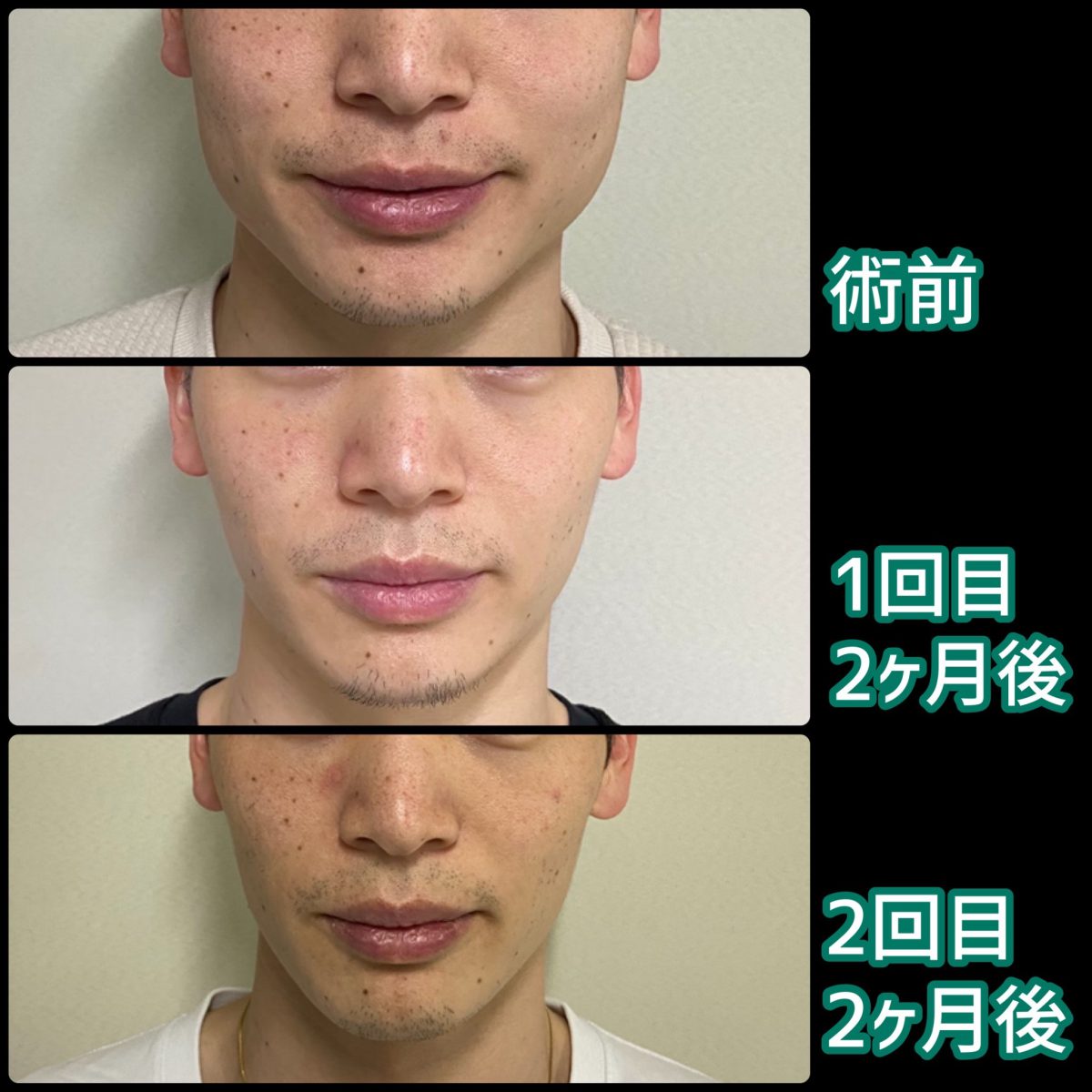 エラボトックスを打ち続けると老ける？たるみと耐性の真相と適切な頻度を徹底検証