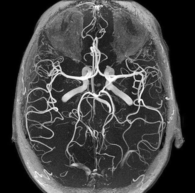 50メートル走の世界記録は5秒56！ボルト幻のタイムと男女歴代まとめ