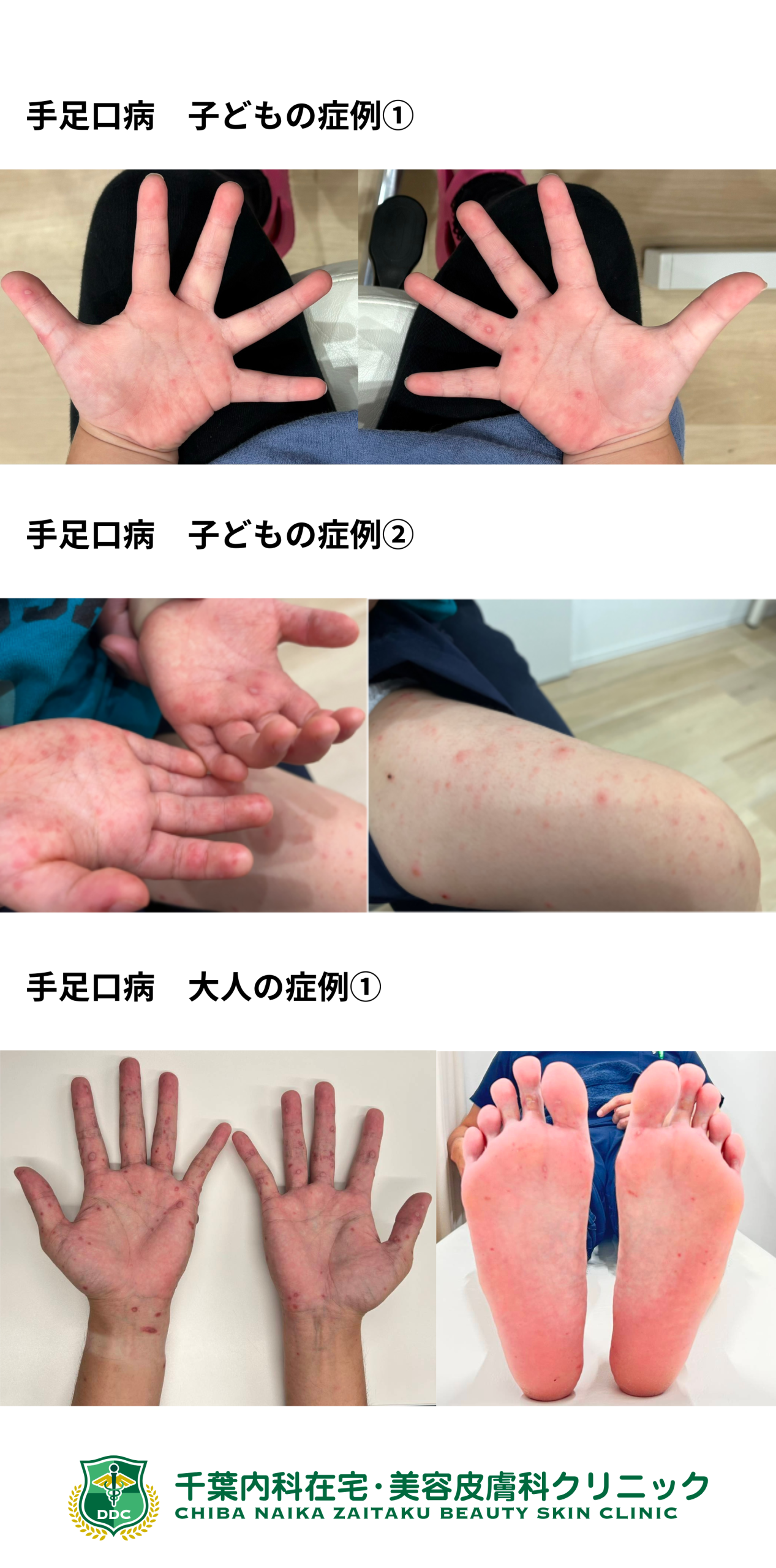 手足口病が大人にうつる確率と重症化リスク最新警戒情報