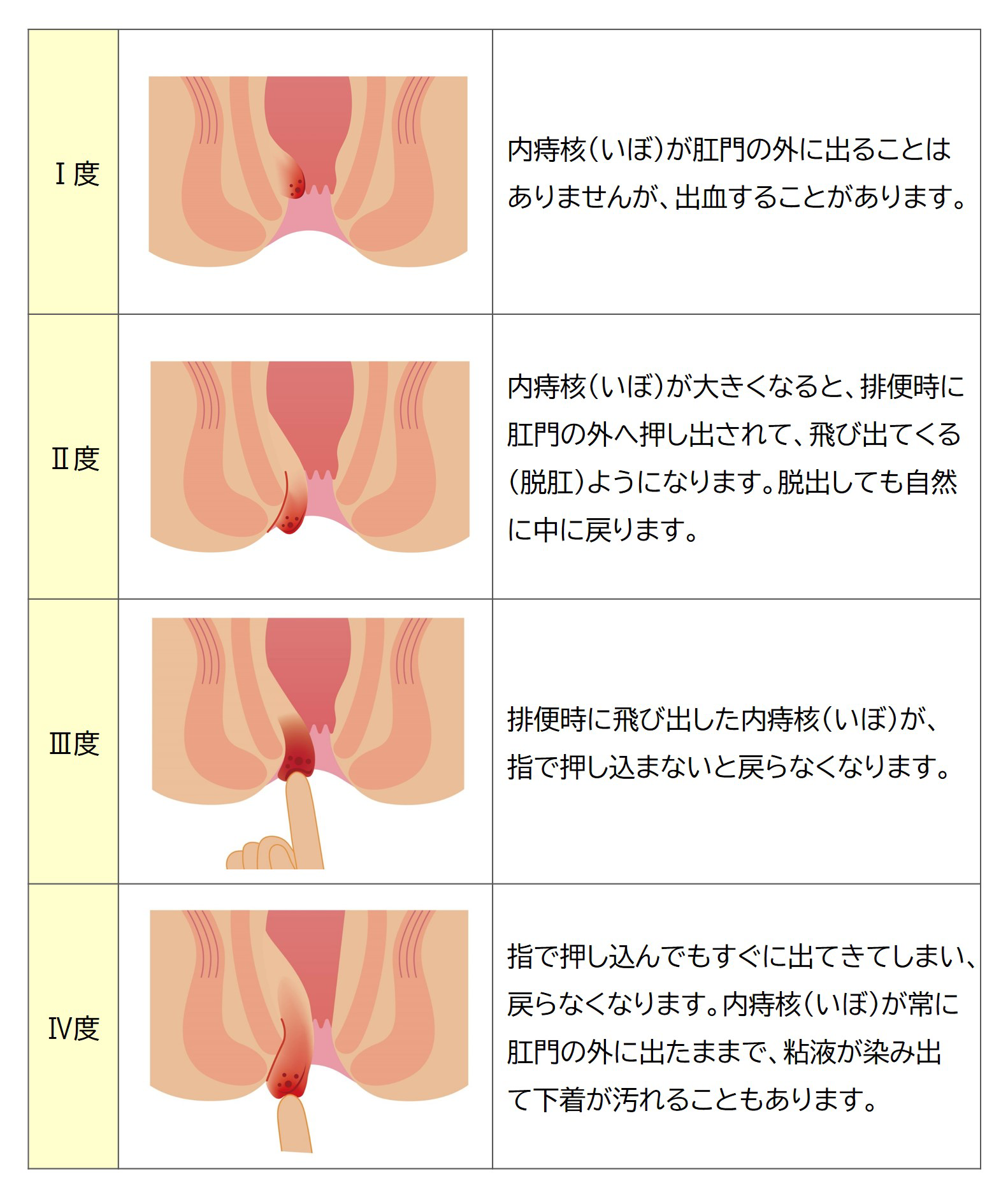 脱出したいぼ痔の押し込み方と治し方｜無理に戻すと悪化する危険性