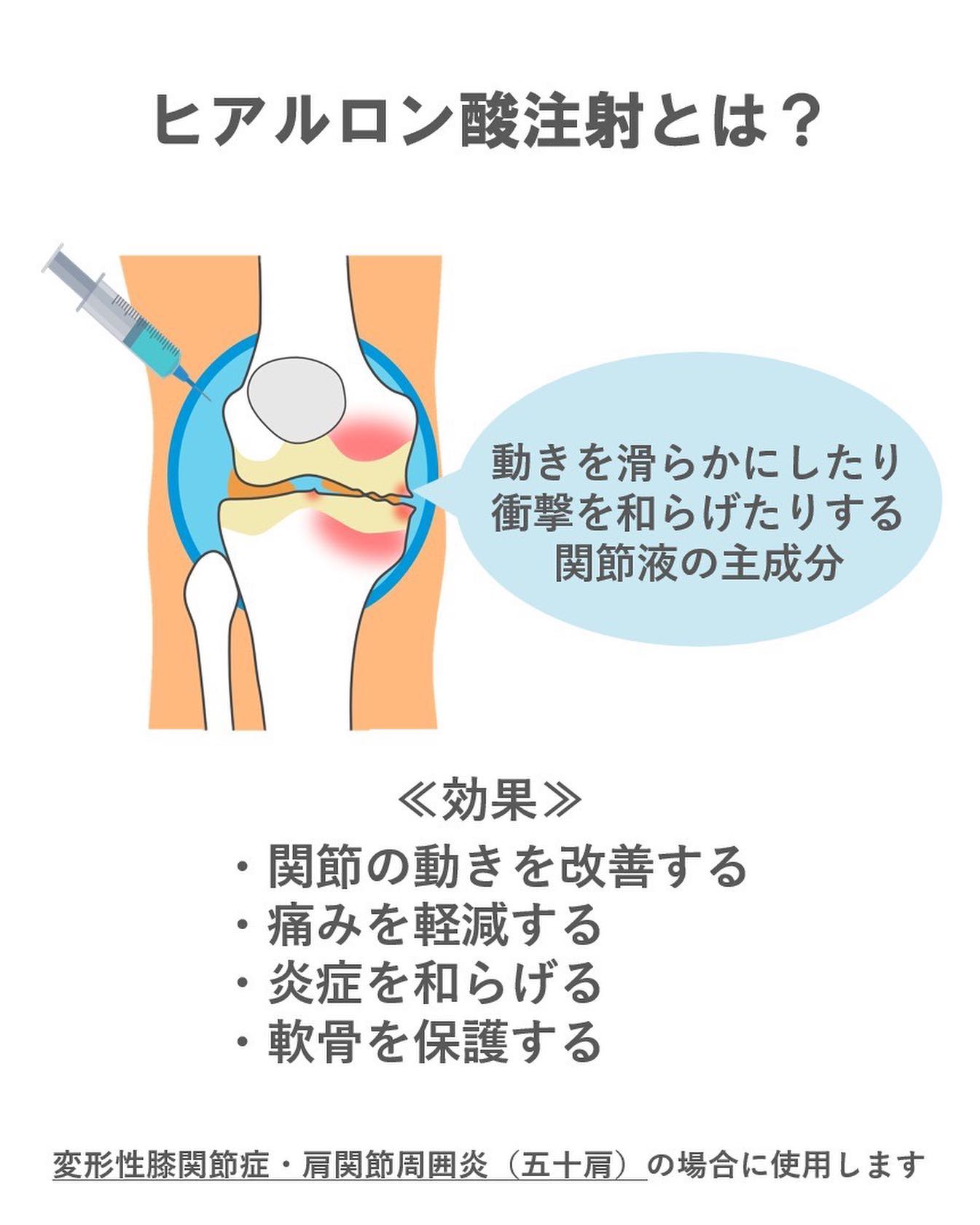 膝のヒアルロン酸注射の効果と効かない理由｜持続期間や費用を徹底解説