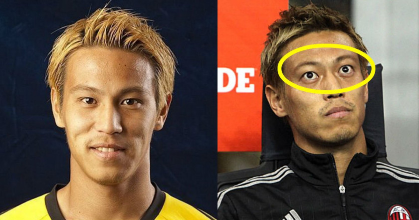 本田圭佑とバセドウ病「隠された10年目の真実」——首の傷跡、激変した眼球、それでもピッチに立ち続けた男の2026年現在