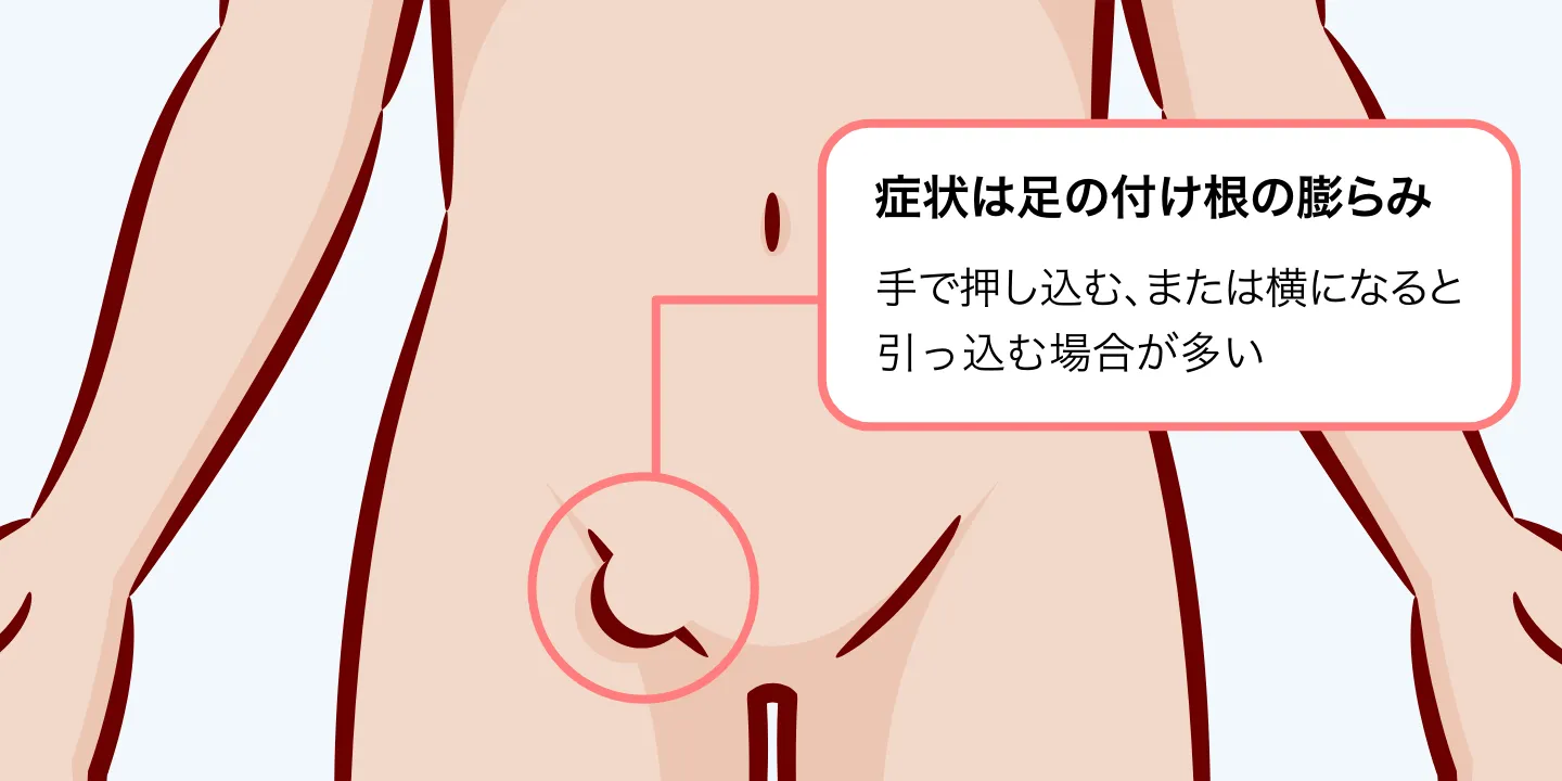 足の付け根のしこりは危険？痛い・痛くない原因と病院の選び方を徹底解説