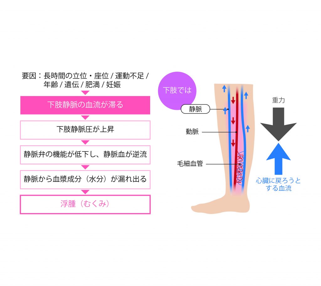 足のむくみの原因｜放置すると命に関わる危険なサインと正しい解消法
