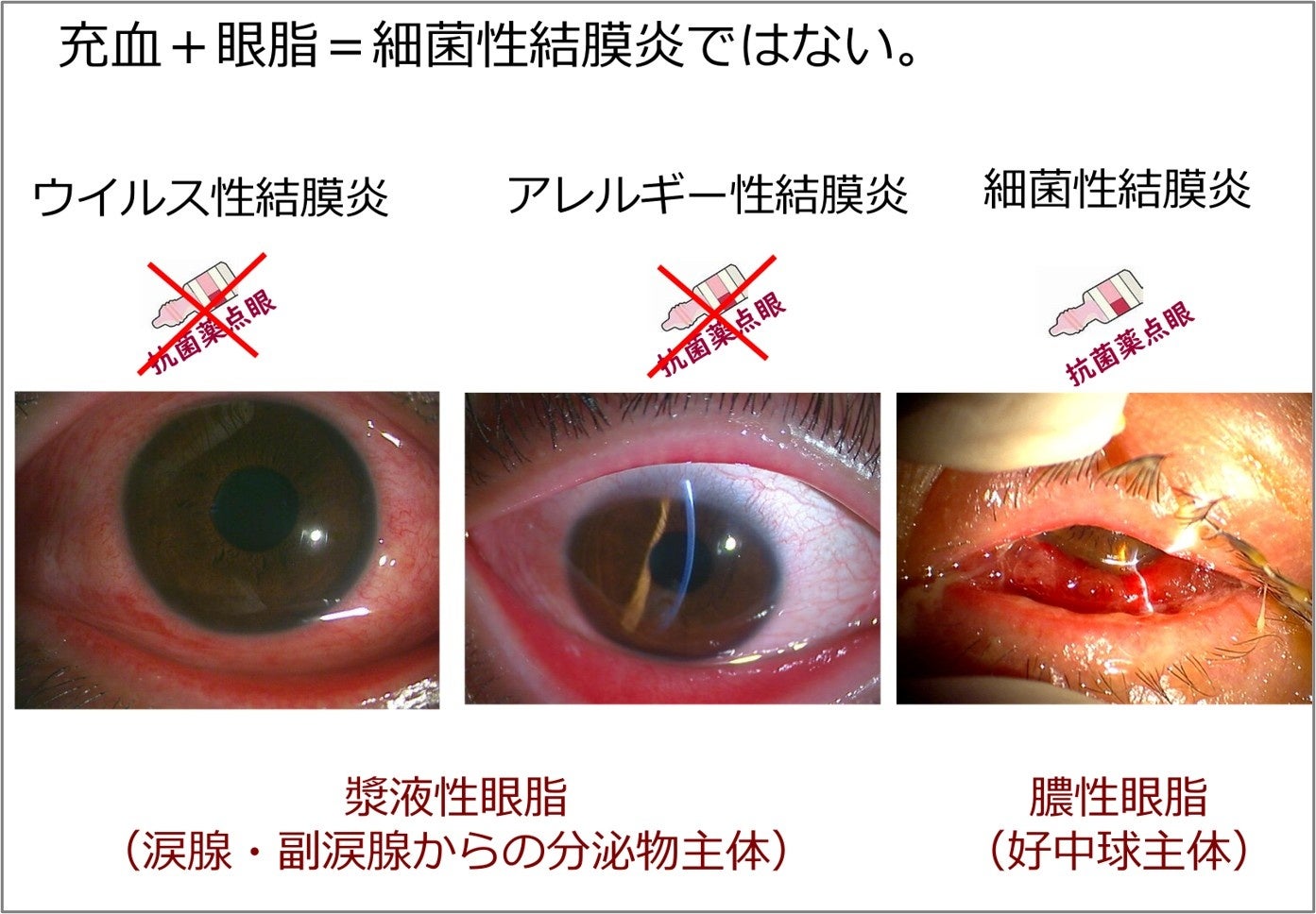 結膜炎の細菌性とウイルス性の見分け方｜目やにの色や感染力で判別する基準
