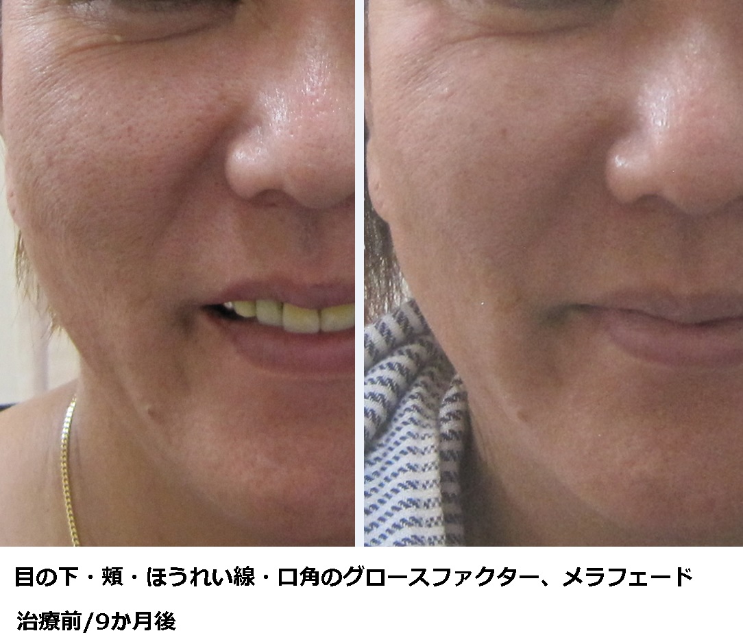 笑うと口の横にしわが走る原因は？老け見えを防ぐ2026年最新ケア