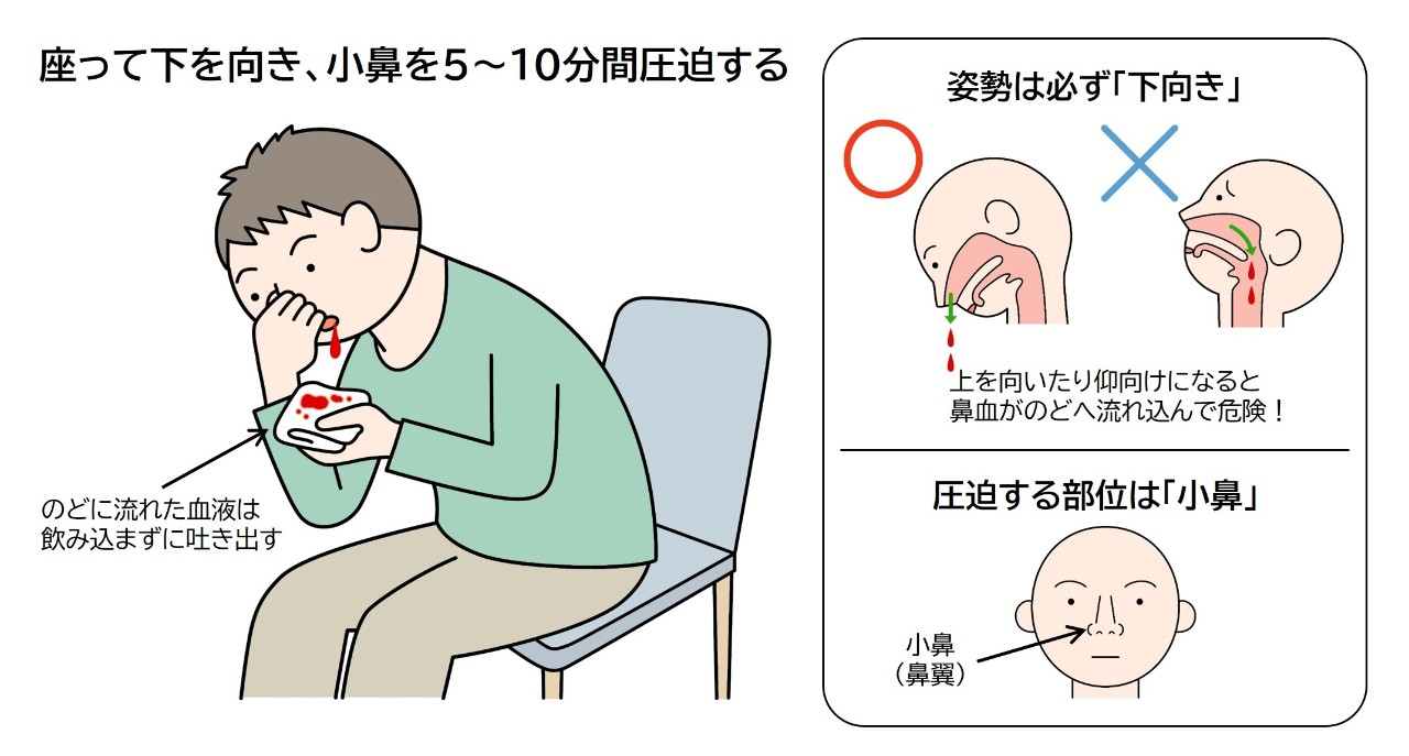 大量の鼻血が止まらない原因と危険なサイン｜正しい対処法と受診の目安を徹底解説