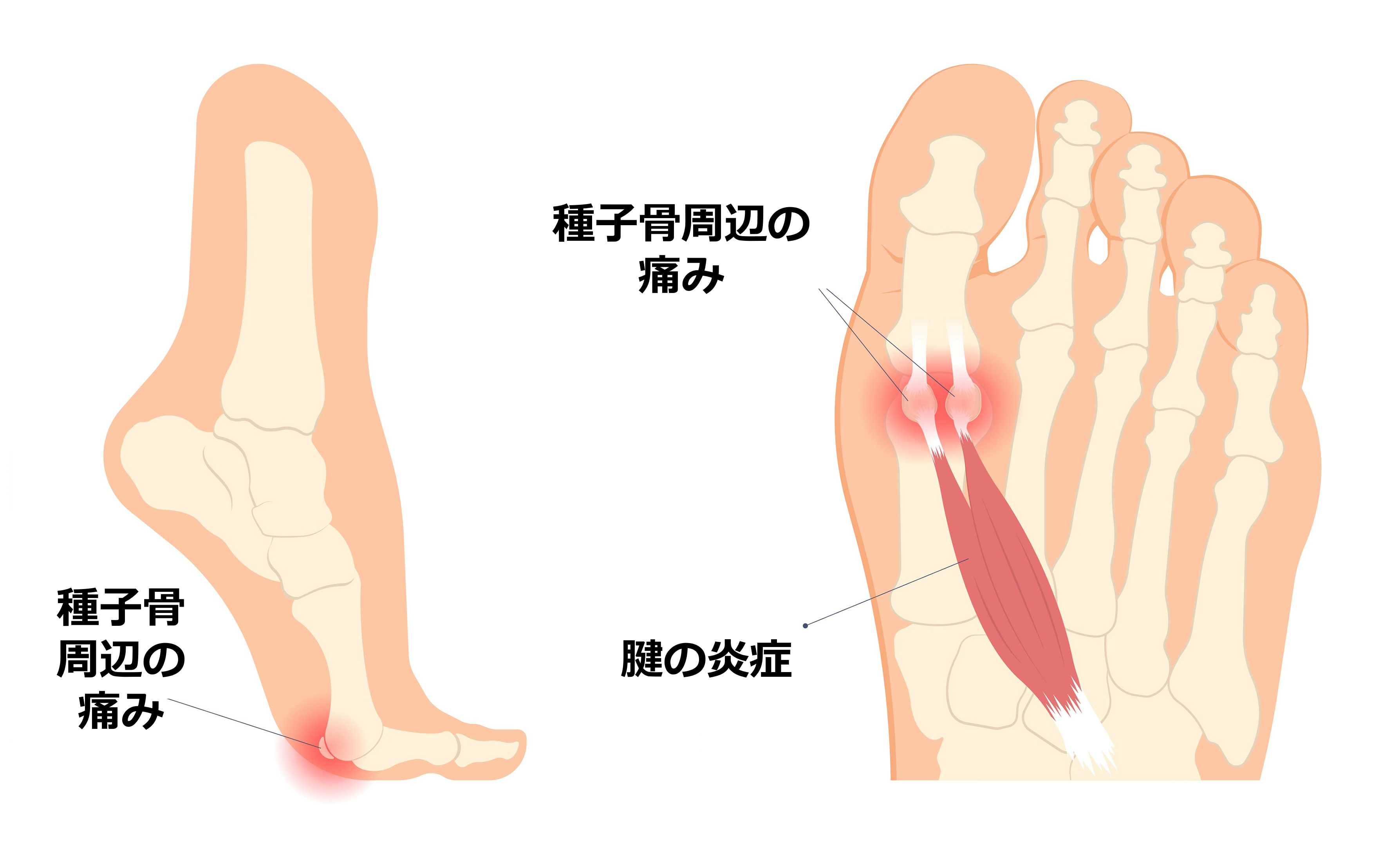 足の指の間が痛い原因を徹底究明！モートン病・水虫の見分け方と対処