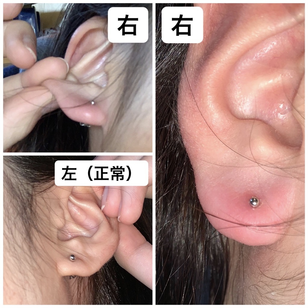 ピアスで耳が腫れる原因とは？外すべきかの判断基準と正しい治し方