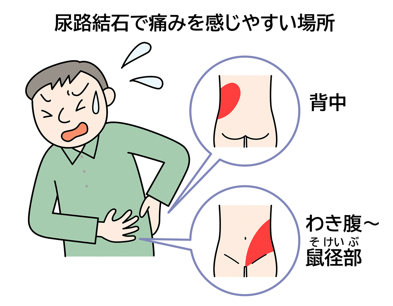 腎臓結石の激痛はどう抑える？今すぐできる対処法と救急車を呼ぶ基準