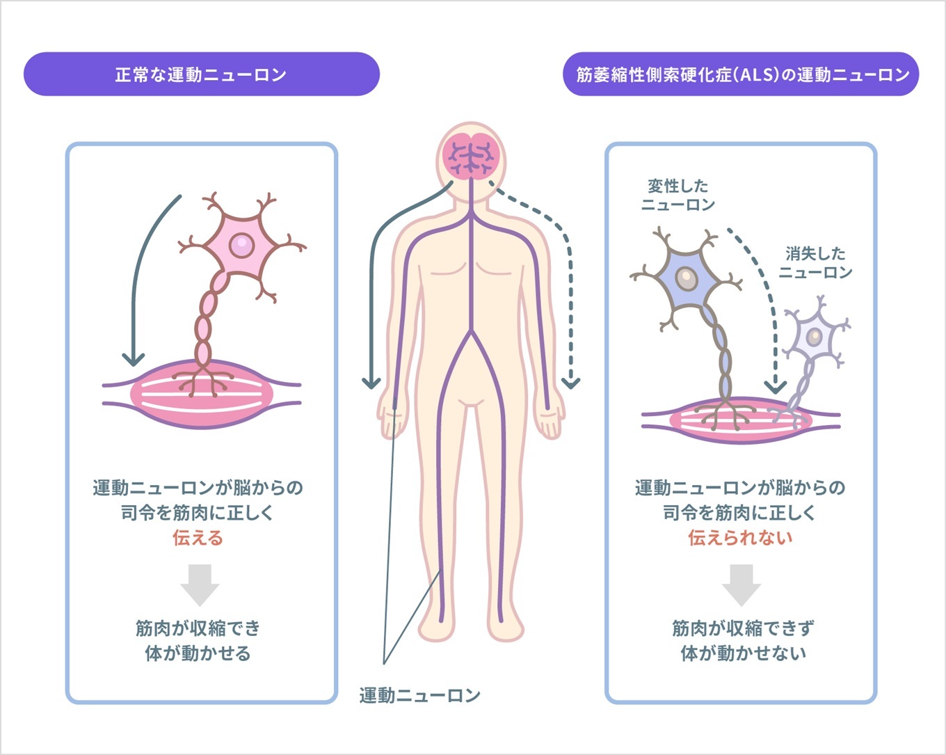 筋萎縮性側索硬化症の原因と遺伝確率｜最新創薬とメカニズムの真実