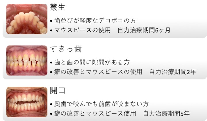 歯並びを自力で治す危険性とは？歯科医師が明かす真相と最新矯正法